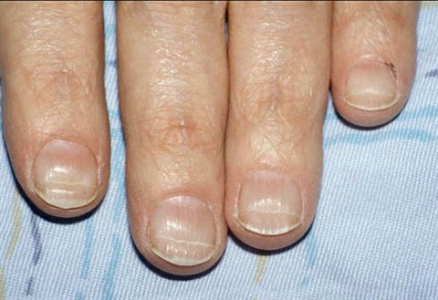 Close-up of four fingernails showing horizontal ridges across the nail plates on a light fabric background