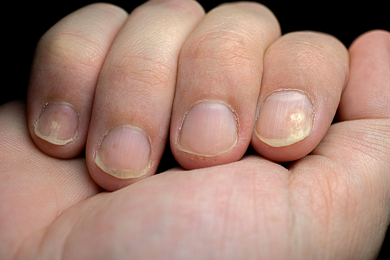 Close-up of four fingernails showing yellow discoloration, ridging, and pitting against a dark background
